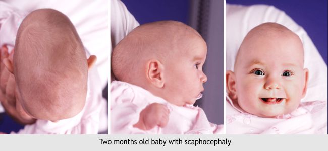 scaphocephaly